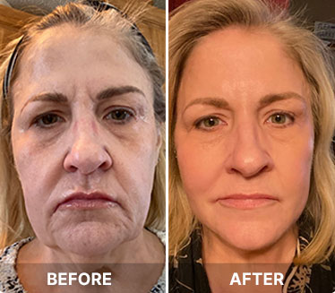 Before and after results