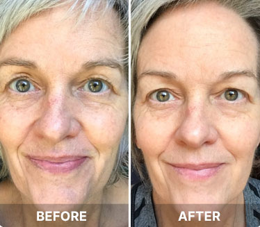 Before and after results